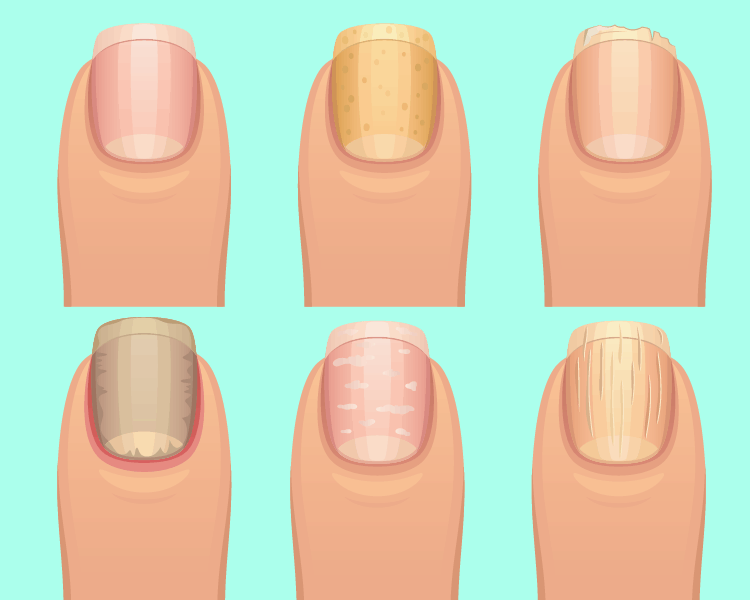 11 Health Problems You Can Detect By Looking At Your Nails - FamilyToday