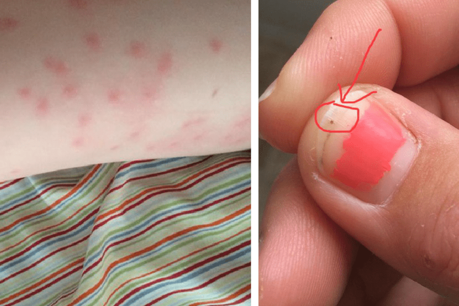 Mom Notices Tiny Black Dots Covering Her Child s Skin And Thinks 