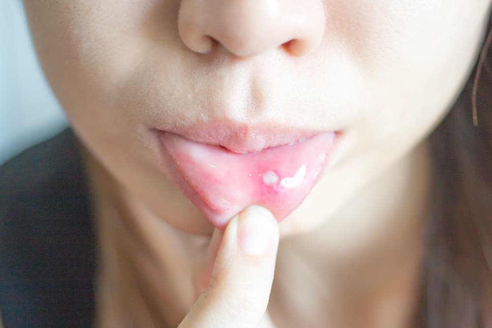 find-out-what-the-appearance-of-white-spots-on-your-lips-indicates