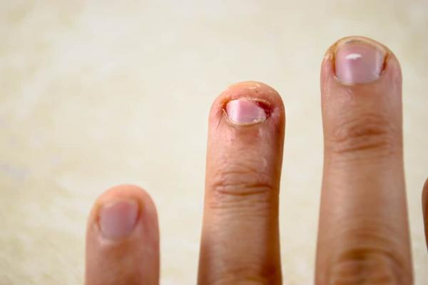 5 Dangerous Infections You Can Get When You Bite Your Nails FamilyToday