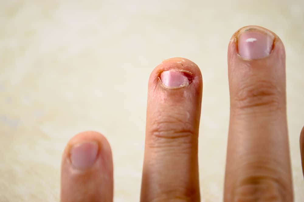 5 dangerous infections you can get when you bite your nails - FamilyToday